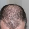 Studie zeigt: Reines Kürbiskernöl hilft gegen genetisch bedingten Haarausfall